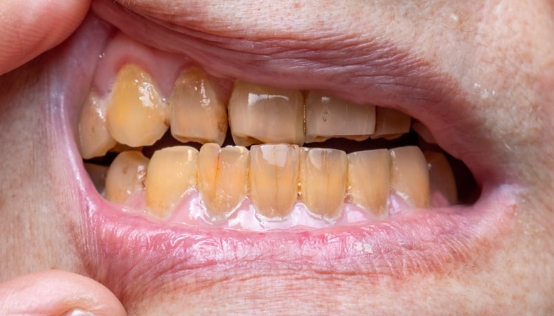انواع تغییر رنگ دندان