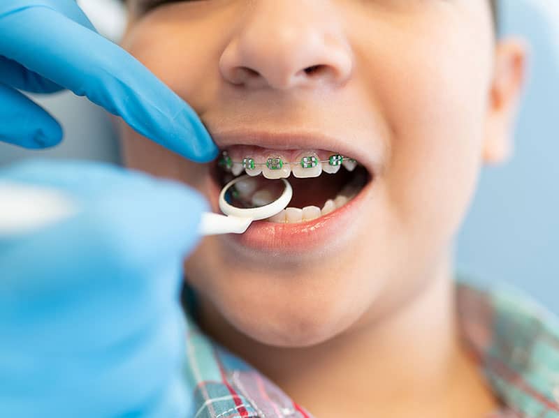 سن مناسب شروع ارتودنسی دندان ها