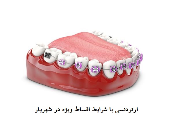 ارتودنسی اقساطی در شهریار
