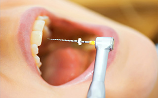 عصب کشی دندان در زمان ارتودنسی