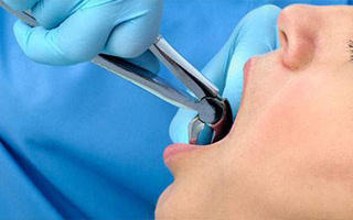 کشیدن دندان در زمان ارتودنسی