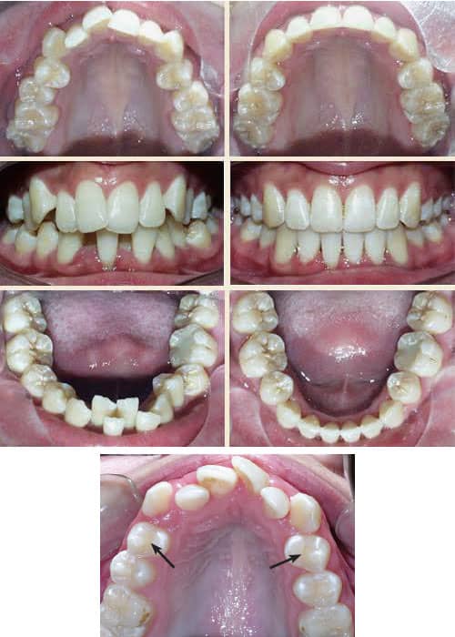 کشیدن دندان شماره ۴ در ارتودنسی