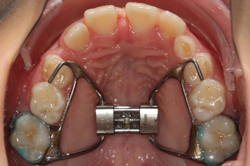 پالاتال اکسپندر یا وسیع کننده کام برای جلوگیری از کشیدن دندان در ارتودنسی