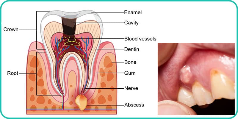 آبسه یکی از عوارض عفونت دندان