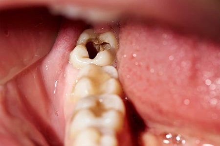 عفونت دندان