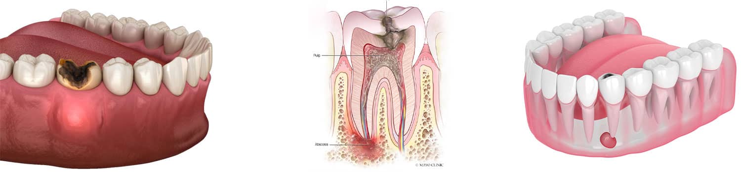 راه های درمان عفونت دندان