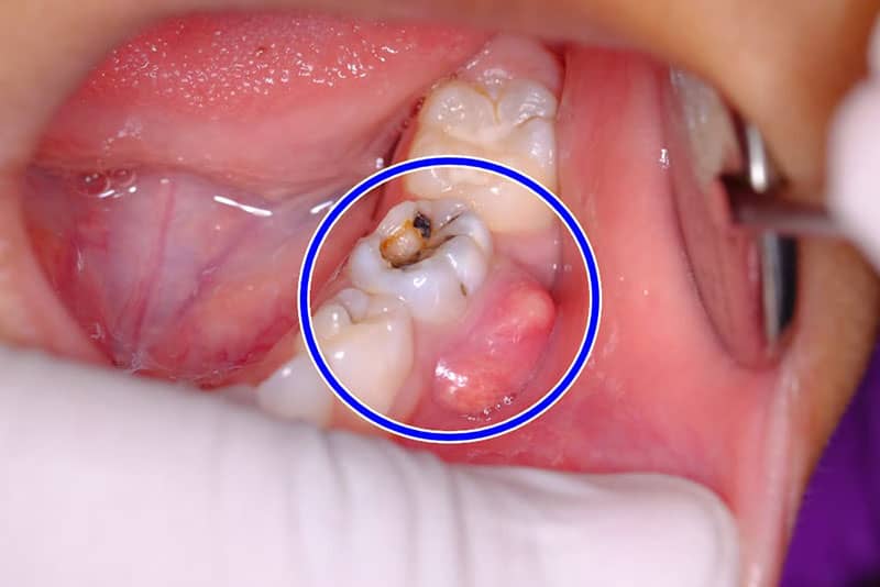 عفونت دندان چیست