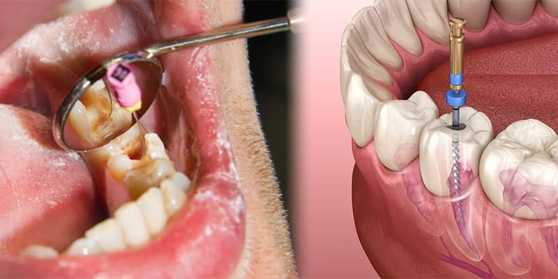 عصب کشی برای درمان عفونت دندان