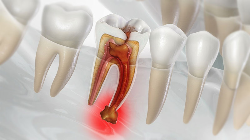 چگونه عفونت دندان را خارج کنیم؟