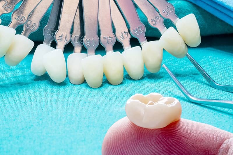 روکش دندان یک نوع پروتز دندان ثابت