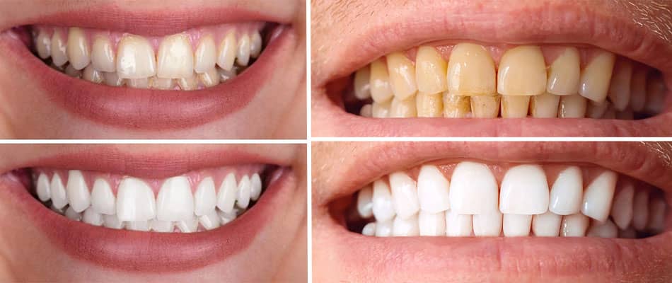 طول عمر و دوام بلیچینگ دندان