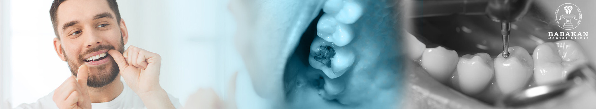 مراقبت از دندان بعد از ترمیم و پر کردن