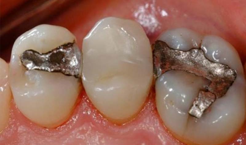 مراقبت بعد از ترمیم دندان