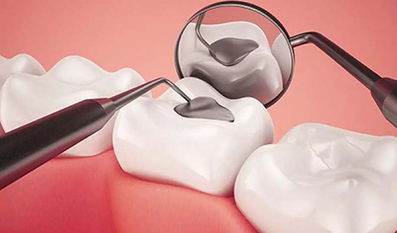 روش های مراقبت از دندان بعد از ترمیم و پر کردن
