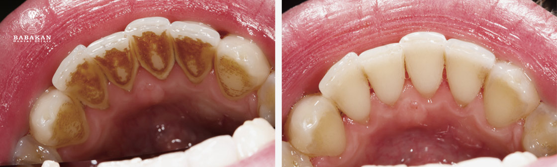 تاثیر درمانی جرمگیری دندان چیست؟