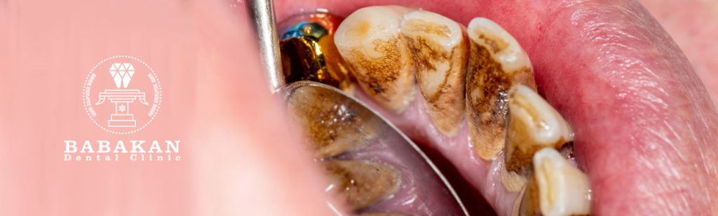 مدت زمان جرم گیری دندان چقدر است؟