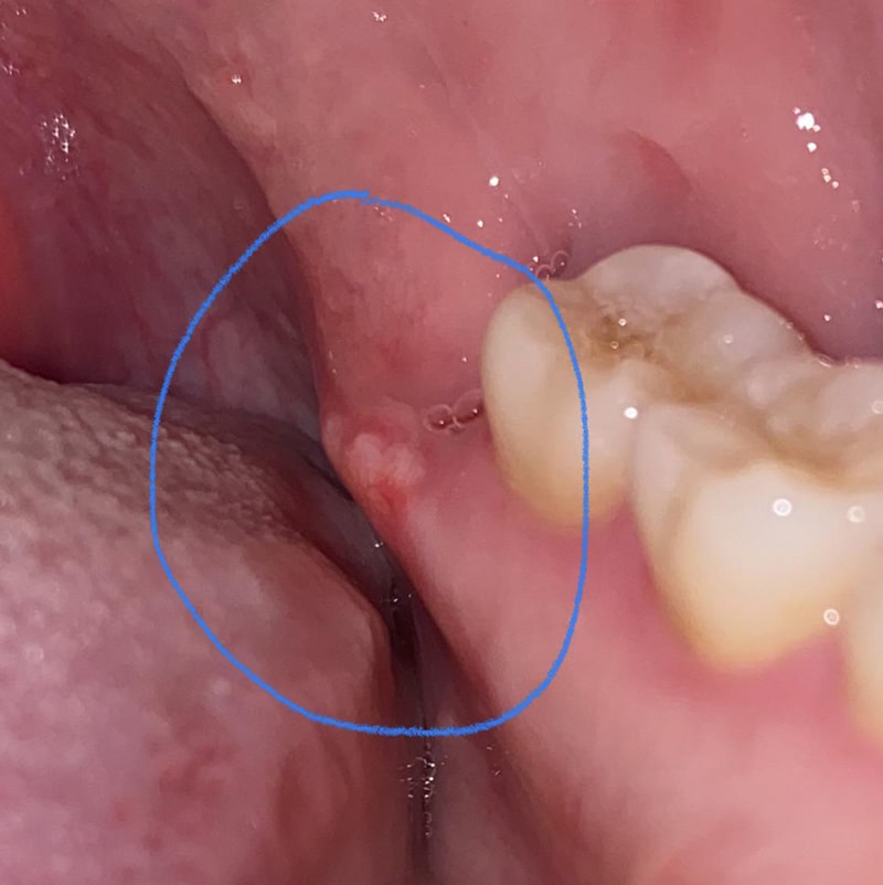 استخوان لثه بعد از کشیدن دندان