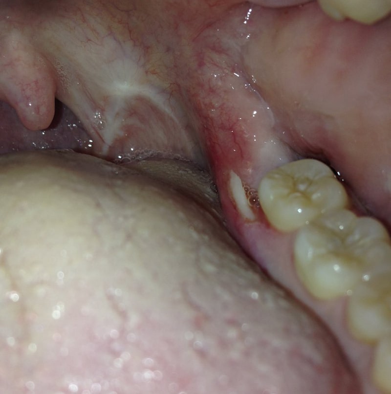 عکس استخوان فک بعد از کشیدن دندان