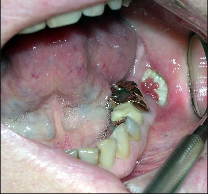 بیرون زدن استخوان فک بعد از کشیدن دندان