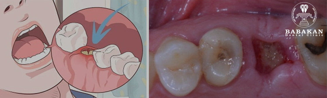 دلیل بیرون زدگی استخوان فک بعد از کشیدن دندان