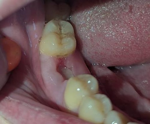 علت احساس تیزی بعد از کشیدن دندان