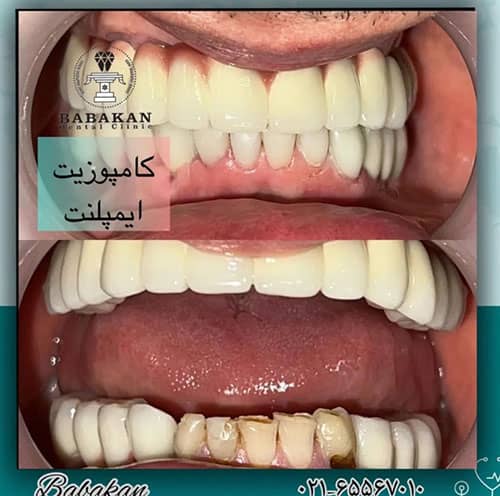 درمان ترکیبی کامپوزیت و ایمپلنت دندان