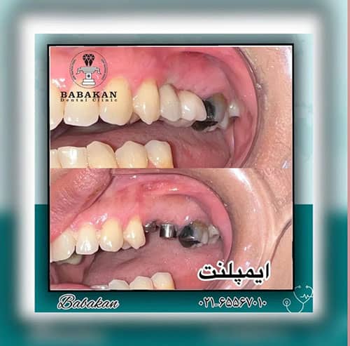 نمونه درمان ایمپلنت دو دندان آسیاب