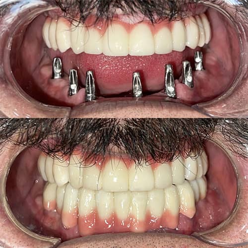 نمونه درمان ایمپلنت دندان توسط دکتر امید امیر بنده