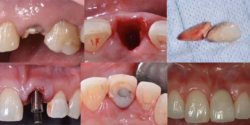 مدت زمان کاشت ایمپلنت بعد از کشیدن دندان