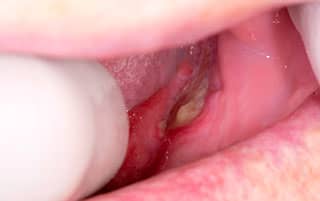 بیرون زدگی استخوان فک بعد از کشیدن دندان
