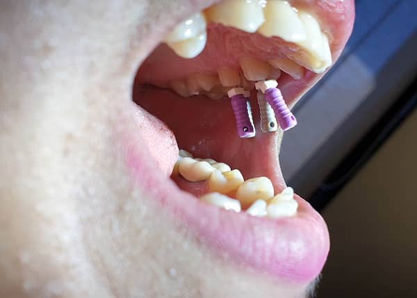 درمان ریشه مرحله دوم طرح درمان دندانپزشکی