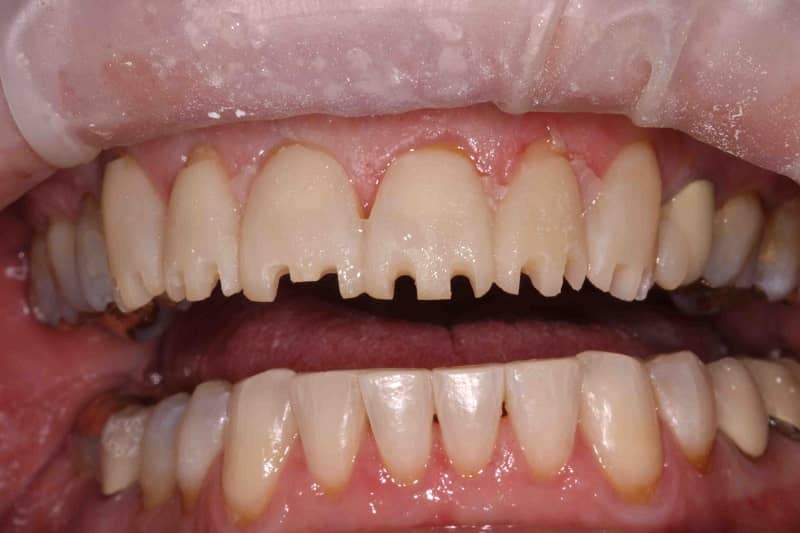 تاثیر دندانپزشک بر میزان تراش دندان در لمینت
