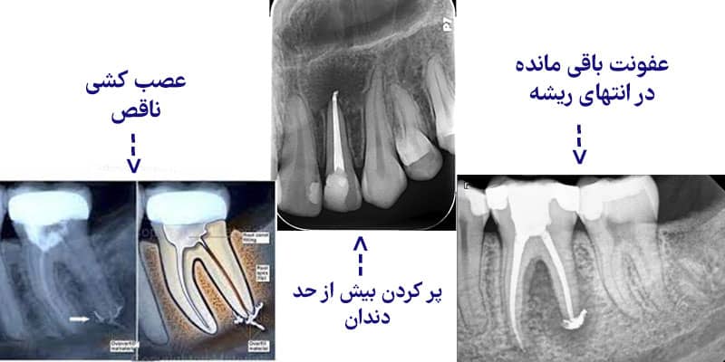 علت ورم و درد دندان بعد از عصب کشی