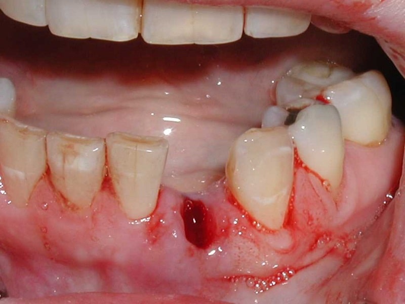 درد و خونریزی بعد از کشیدن دندان