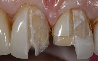 شکستن یا افتادن لمینت دندان چگونه است