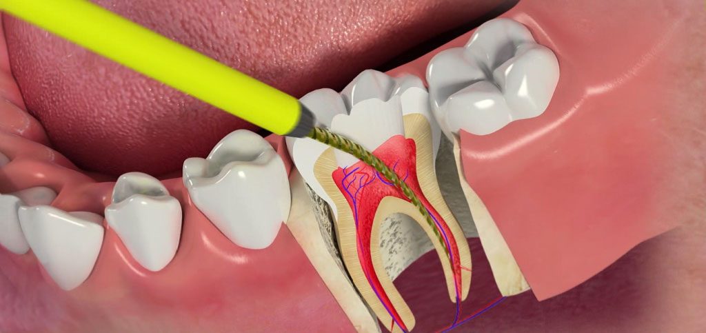 عصب کشی دندان لمینت شده چطور انجام می شود