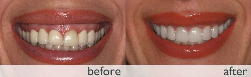 قبل و بعد از اصلاح لبخند