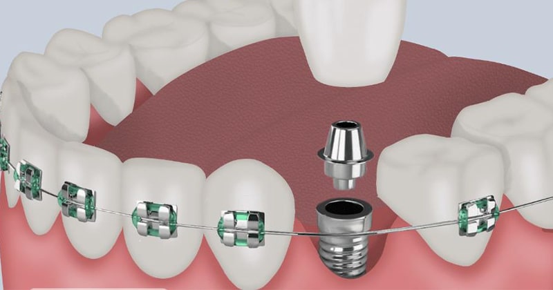 حالت های مختلف دندان ایمپلنت در ارتودنسی