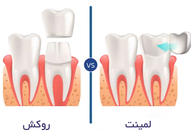 مقایسه لمینت و روکش دندان عصب کشی شده