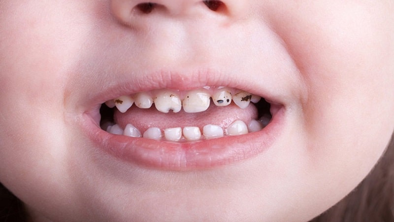علت ایجاد پوسیدگی در دندان کودکان