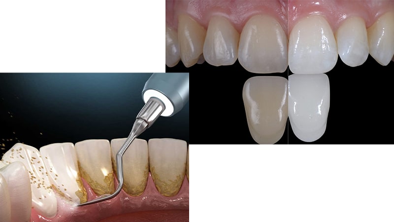 شباهت جرم گیری و بلیچینگ دندان چیست؟