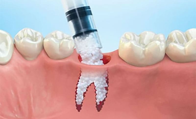 بهترین راه کارها برای کاشت ایمپلنت دندان در افراد مبتلا به پوکی استخوان چیست؟