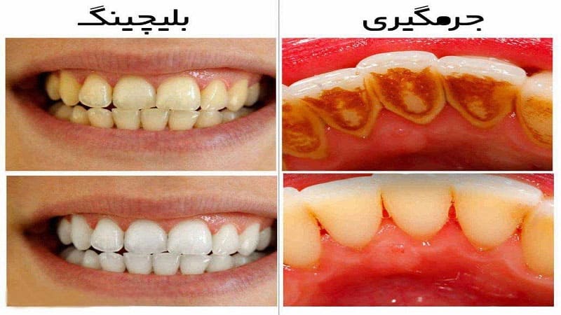 بلیچینگ دندان بهتر است یا جرم گیری؟