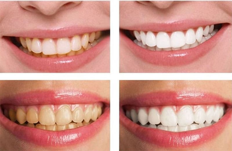 جرم گیری دندان ‌ها را سفیدتر و درخشان ‌تر می کند یا بلیچینگ؟