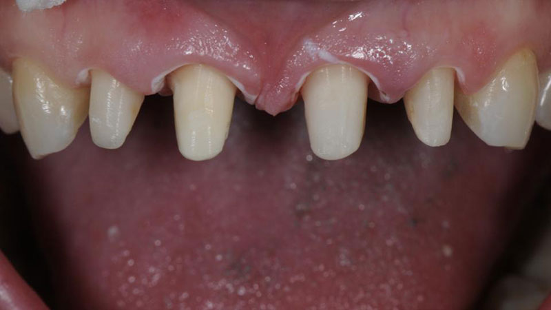 علت درد روکش دندان بدون عصب کشی