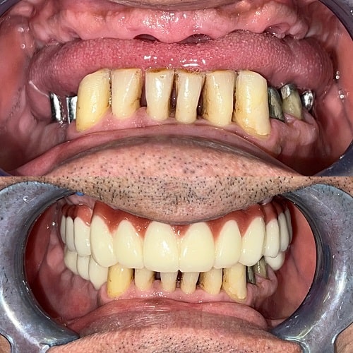 نمونه درمان ایمپلنت فک بالا و سه دندان آسیاب فک پایین