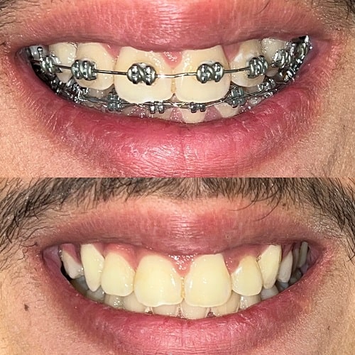 نمونه درمان ارتودنسی ثابت دندان