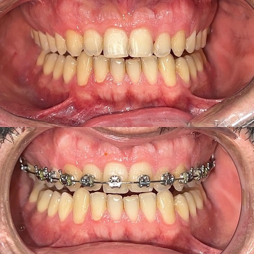 نمونه درمان ارتودنسی ثابت دندان فک بالا