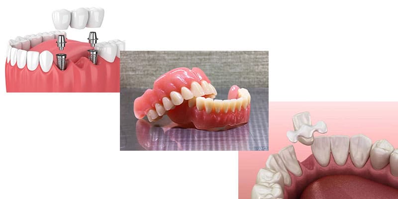 راه های درمان لق شدن دندان چیست؟