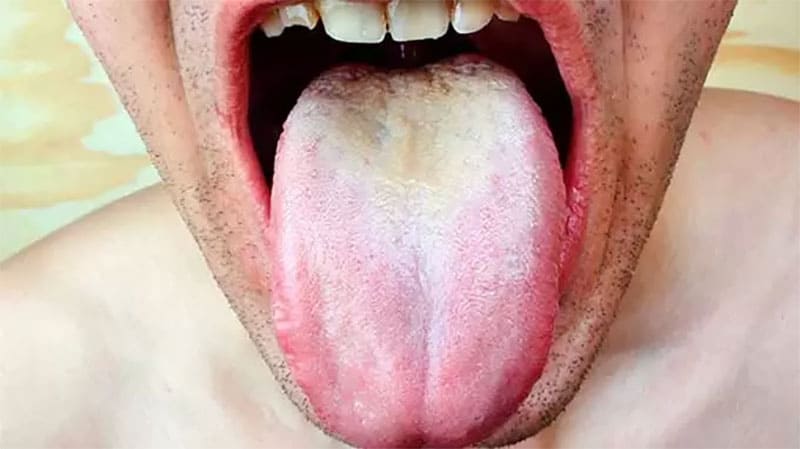 تلخی دهان با زردی زبان نشانه چیست؟